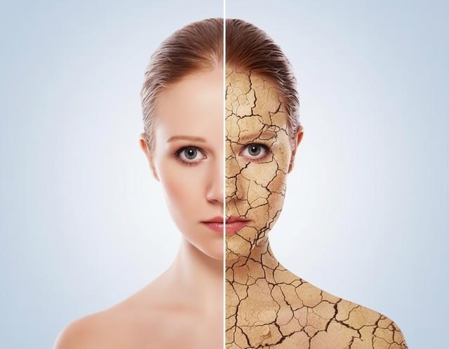 Dehydrated Skin
